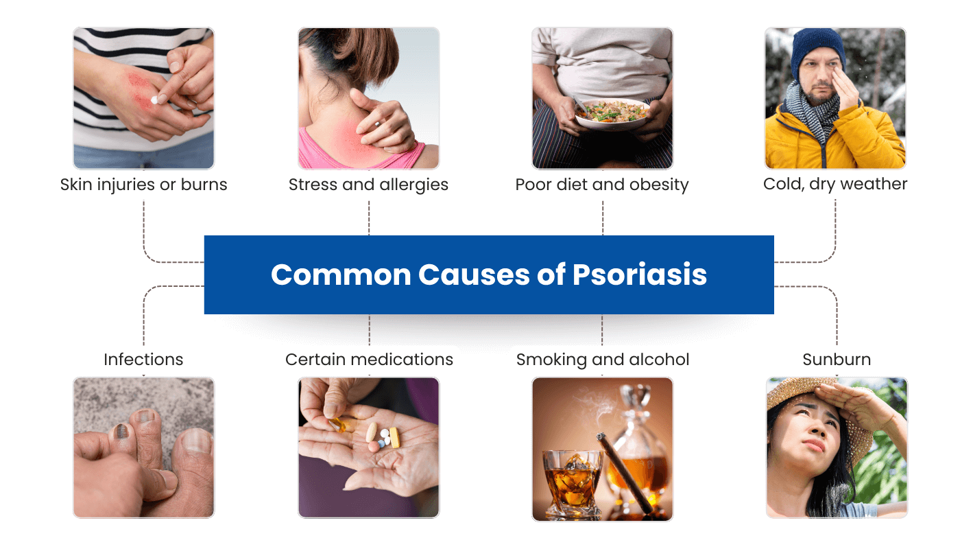 Causes of Psoriasis