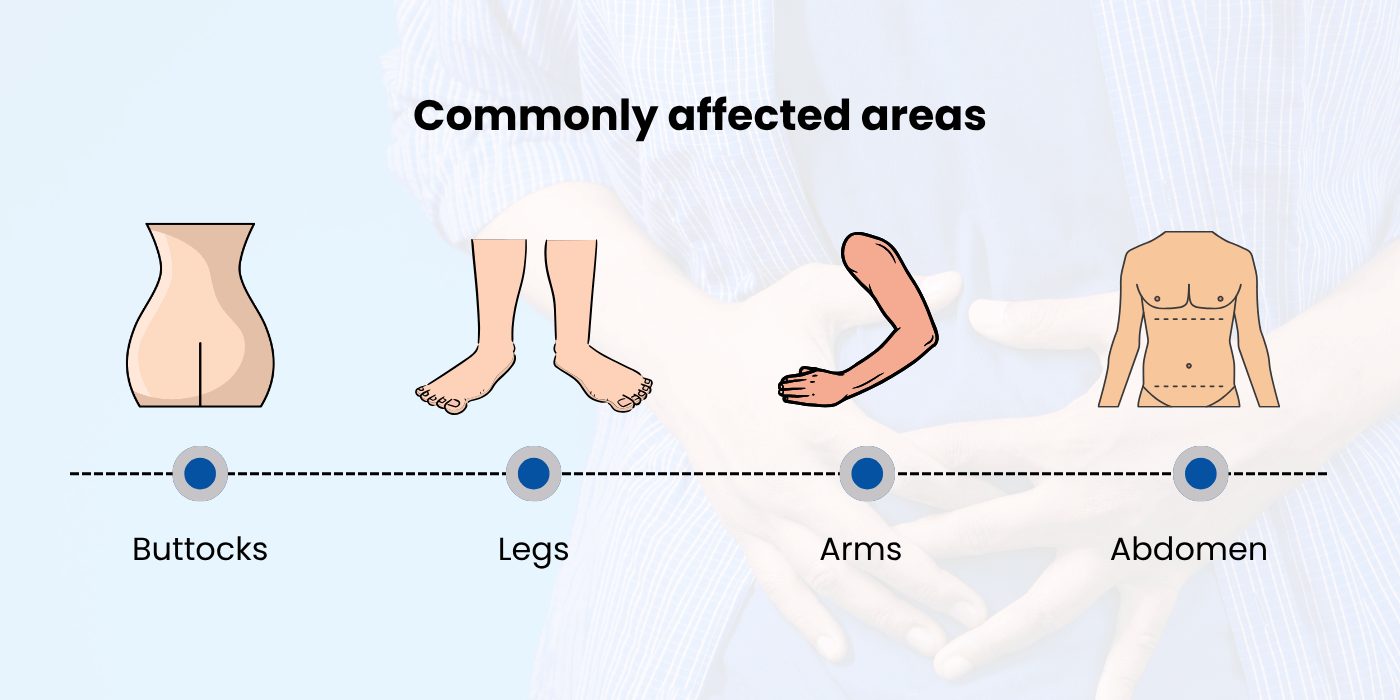 Commonly Affected Areas