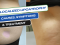 Localized Lipoatrophy Causes, Symptoms & Treatment