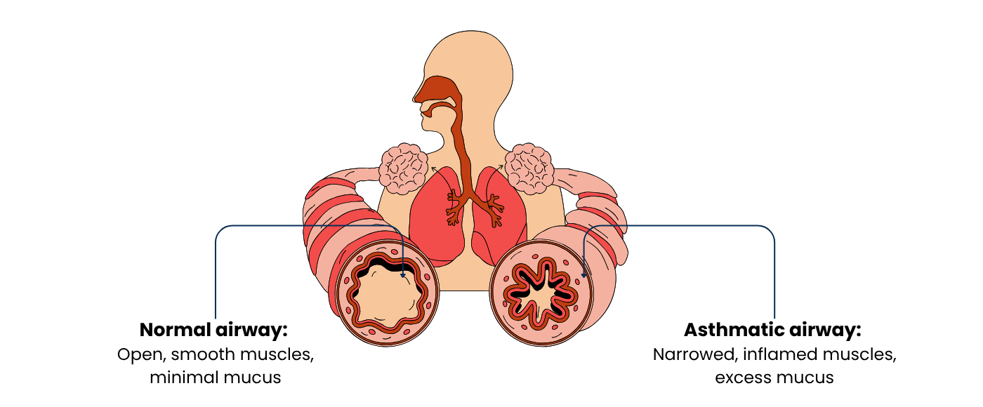 Normal airway vs Asthmatic airway