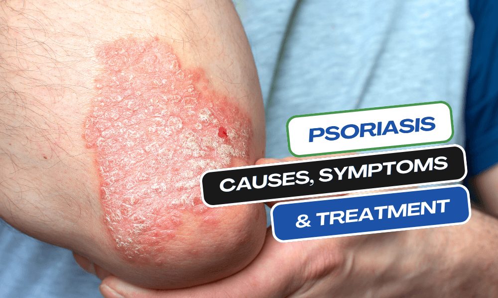 Psoriasis Causes, Symptoms, and Treatment