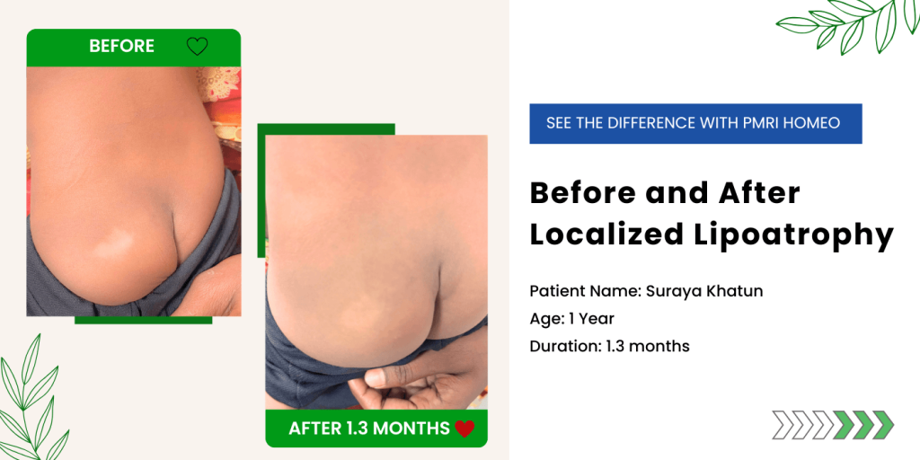 Before After Treatment Localized Lipoatrophy