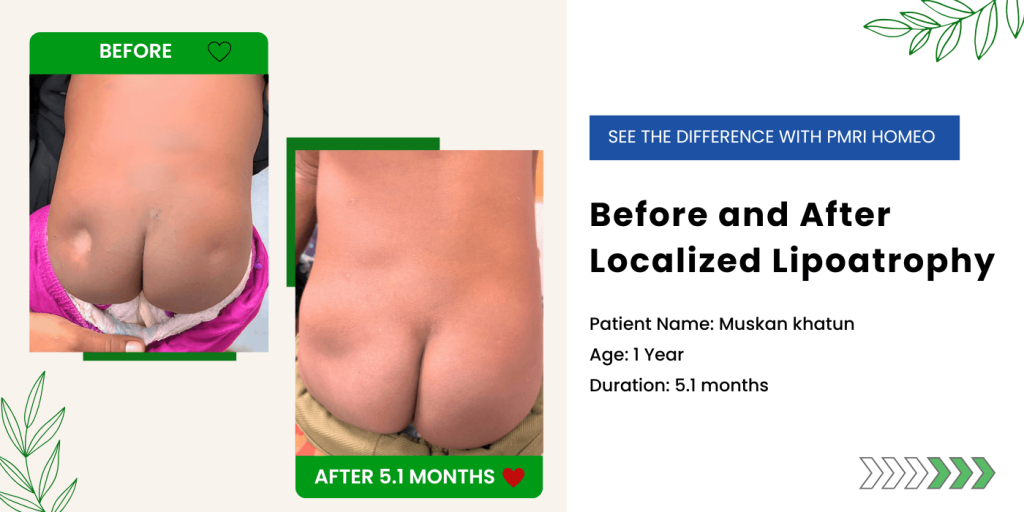 Treatment Localized Lipoatrophy