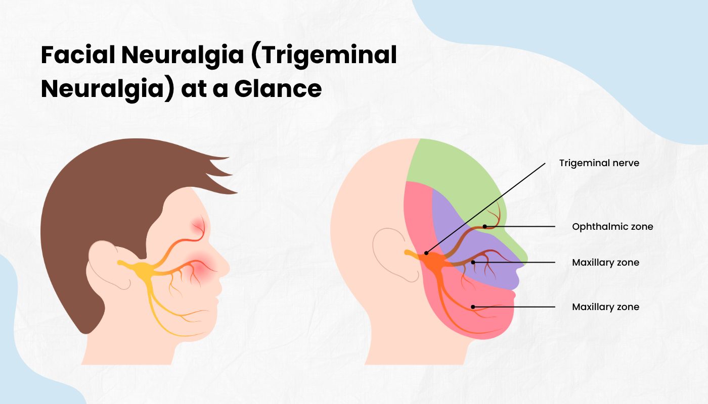 Facial Neuralgia